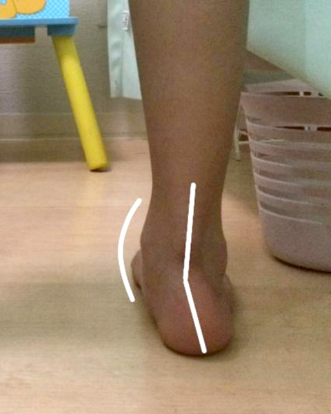 子どもの回内足の足首の画像